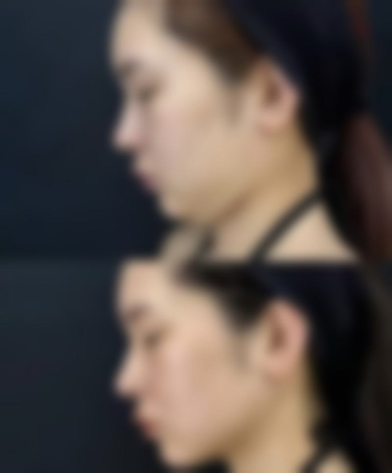瘦脸针打多了脸会下垂吗