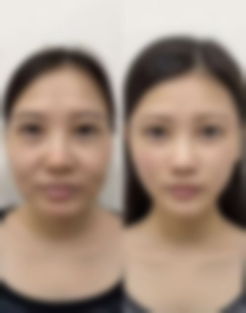 打过瘦脸针后的饮食注意事项